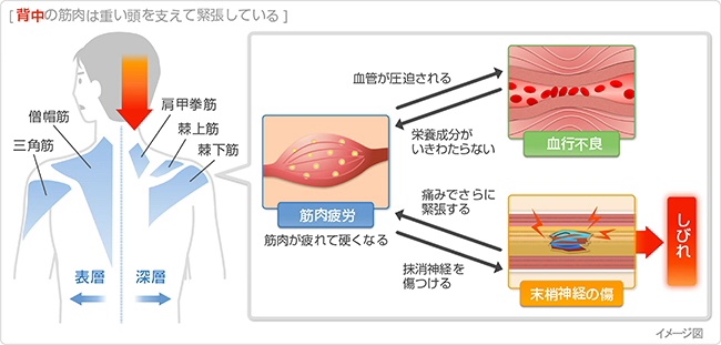 背中の筋肉の緊張と血行不良のメカニズム